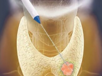 Đốt u tuyến giáp bằng sóng cao tần