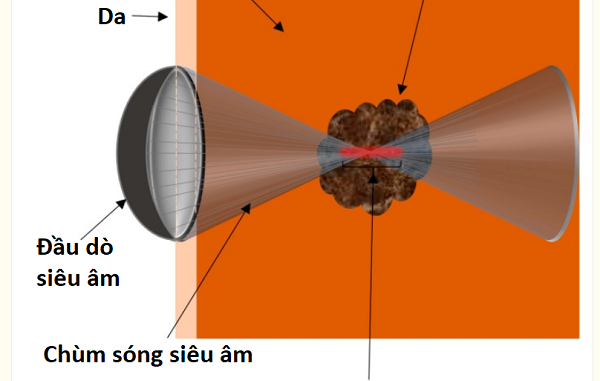 sieu am hoi tu